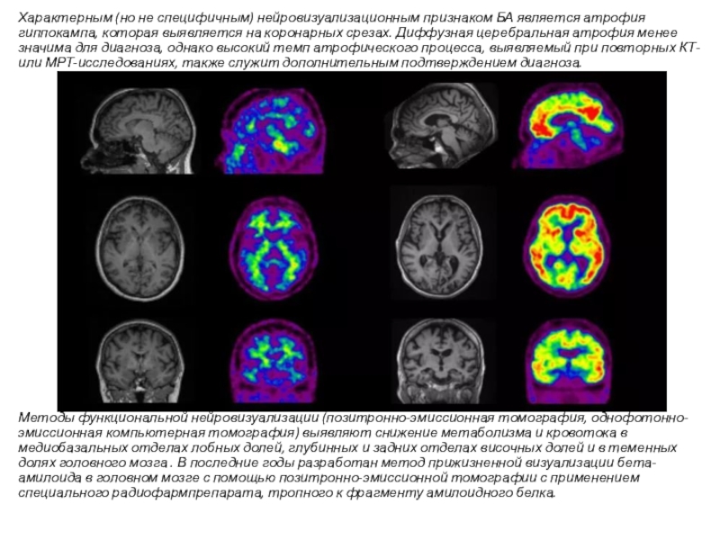 Диффузная церебральная. Церебральная атрофия диффузная церебральная. Атрофия гиппокампов Альцгеймера. Нейровизуализационные исследования головного мозга. Атрофия гиппокампа при Альцгеймера.