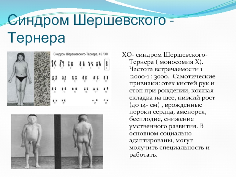 10 синдром шерешевского тернера. Синдром Шерешевского Тернера частота встречаемости. Синдром Клайнфельтера и Шерешевского Тернера. Синдром Шерешевского-Тернера (моносомия х-хромосомы). Синдром Клайнфельтера кариограмма.