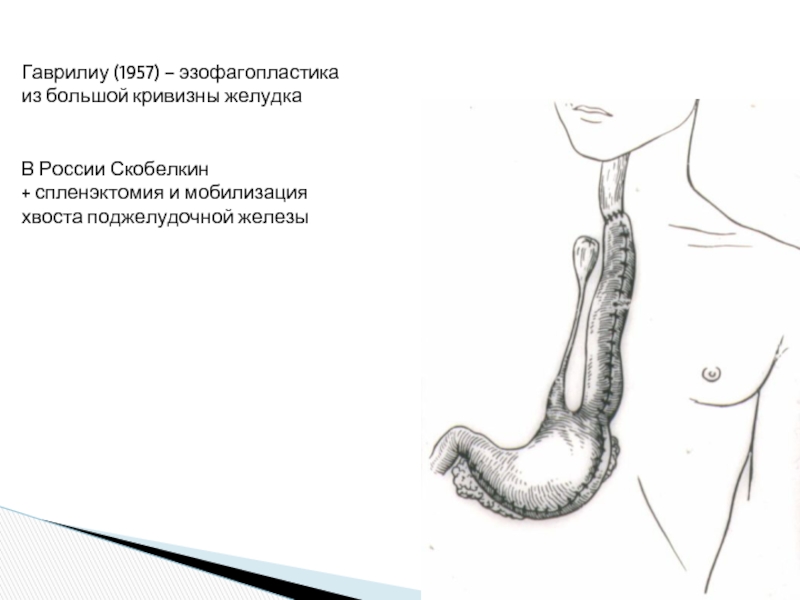 Большая кривизна желудка. Тонкокишечная эзофагопластика по ру Герцену Юдину. Эзофагопластика желудком. Эзофагопластика из большой кривизны желудка. Эзофагопластика пищевода схема операции.