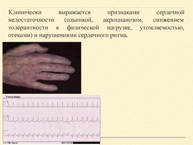 Хроническая ишемия верхних конечностей. Пальцевой тест при ишемии. Значение ишемии.