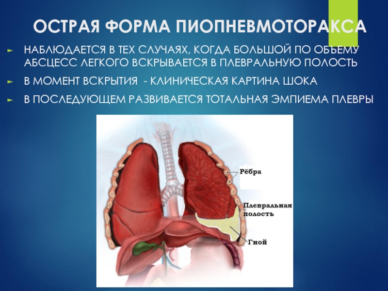 На рентгенологической картине напряженного пиопневмоторакса отмечается смещение средостения в