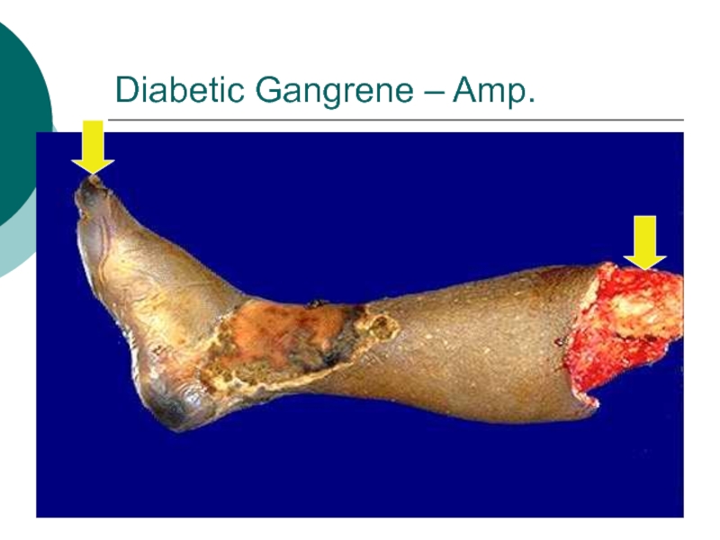 Diabetic Gangrene – Amp.
