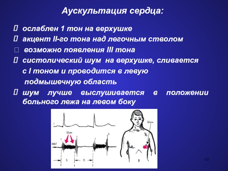 Тону сердца приглушенные. Аускультация сердца 1 и 2 тон. Аускультация акцент 1 тона. Систолический шум на верхушке. 1 Тон аускультация сердца.