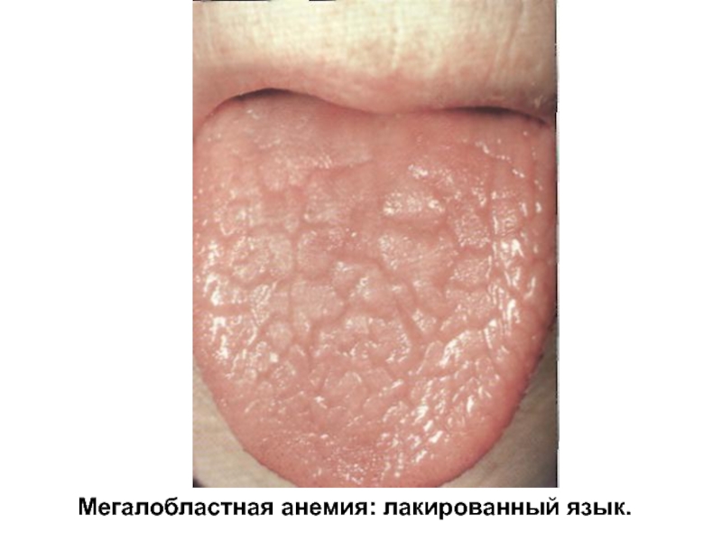 Мегалобластная анемия: лакированный язык.