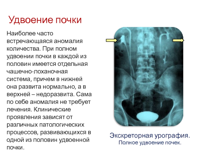 Удвоение левой почки фото