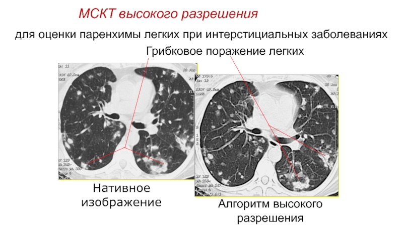 Презентация кт легких