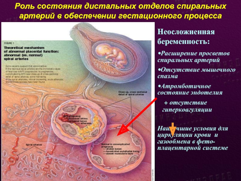 Роль состояния дистальных отделов спиральных артерий в обеспечении гестационного процессаНеосложненная беременность:Расширение просветов спиральных артерий Отсутствие мышечного спазмаАтромботичное