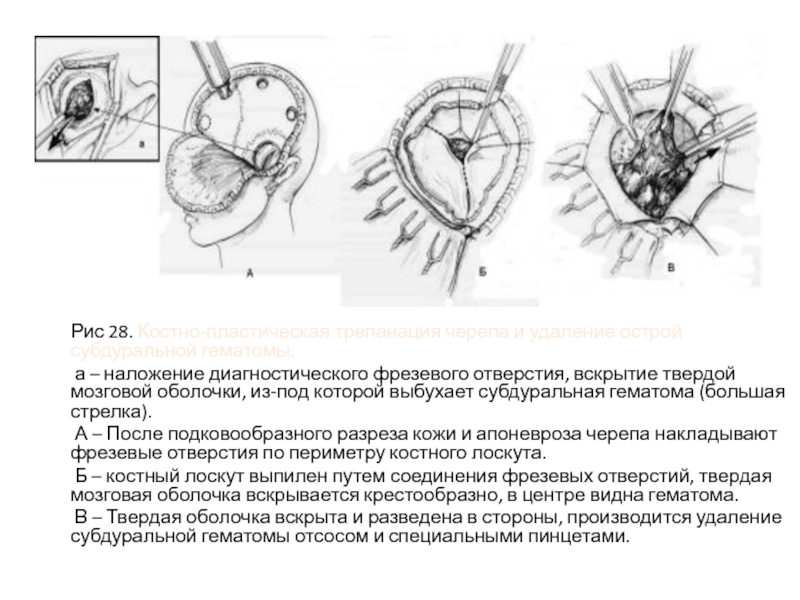 Трепанация треугольника шипо