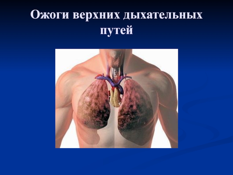 Презентация Ожоги верхних дыхательных путей