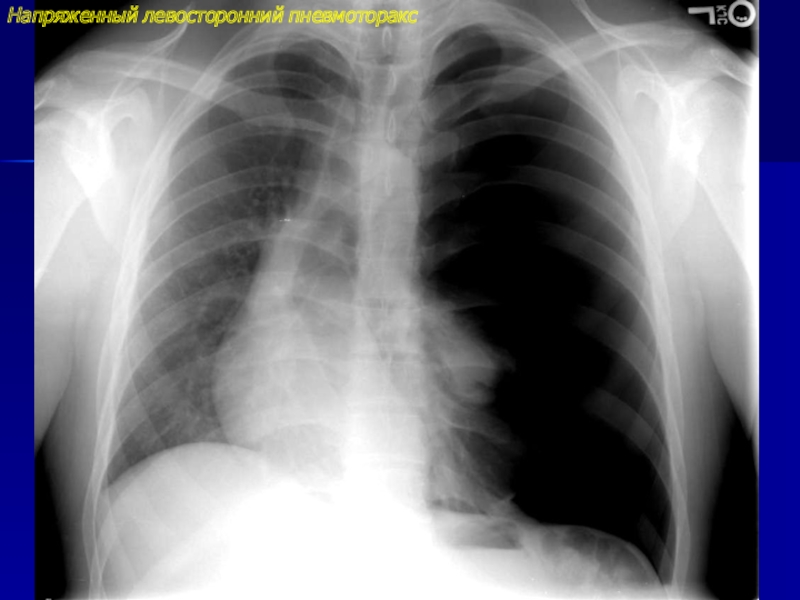 Пневмоторакс на рентгене фото