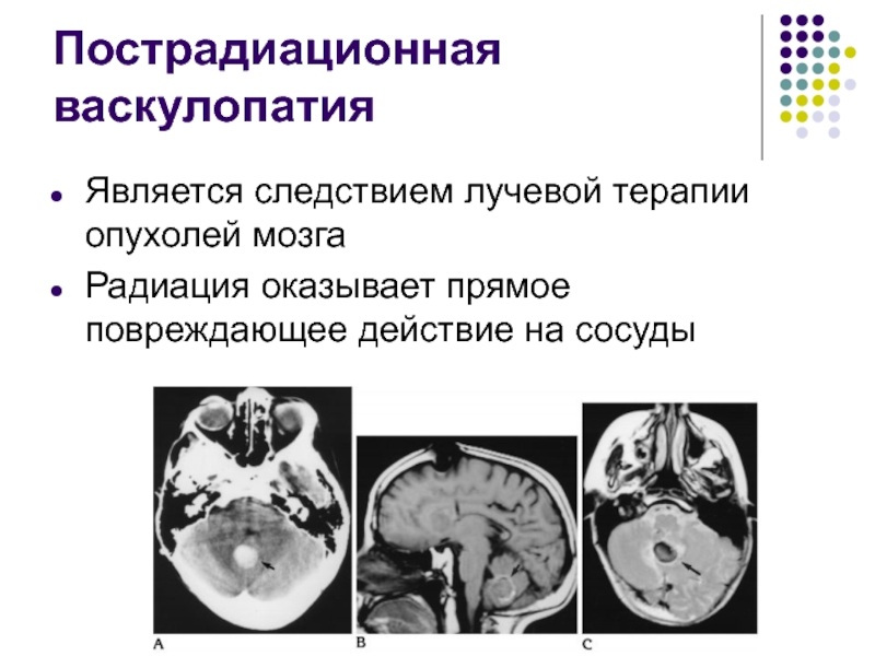 Последствия облучения мозга. Стриарная васкулопатия. Стриарная васкулопатия у новорожденных.