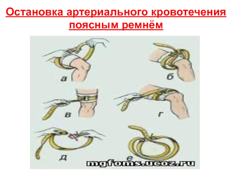 Вместо жгута можно использовать закрутку. Наложение жгута с помощью ремня.