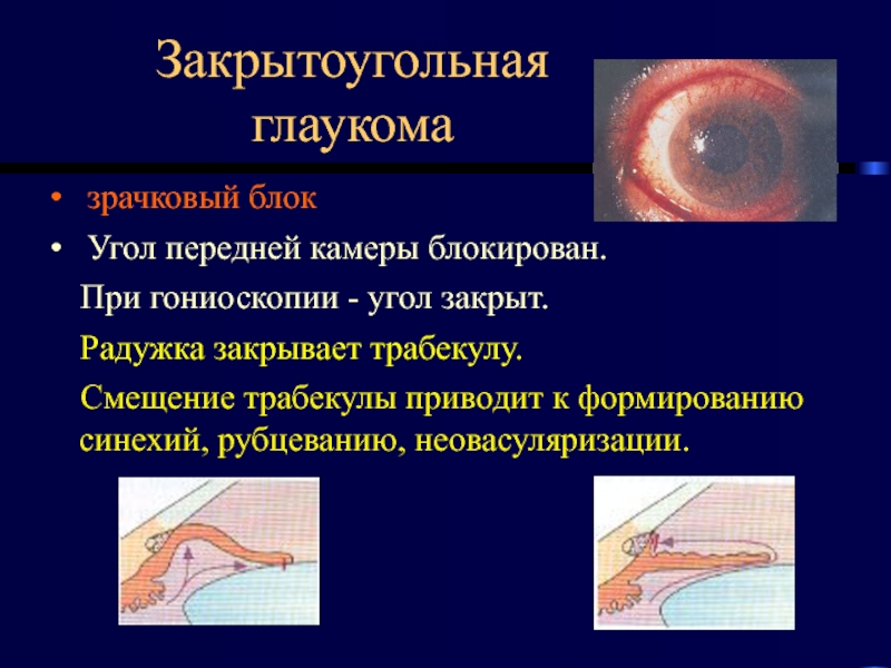 Закрытоугольная глаукома