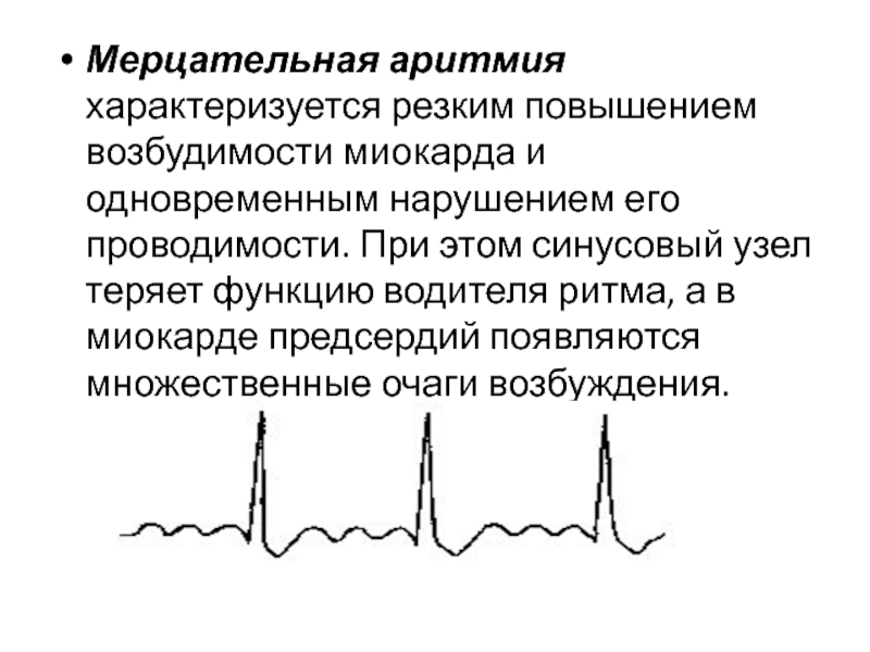 Мерцательная аритмия что это. Мерцательная аритмия. Водитель ритма при мерцательной аритмии. Мерцательная аритмия это фибрилляция. Фибрилляция предсердий характеризуется.