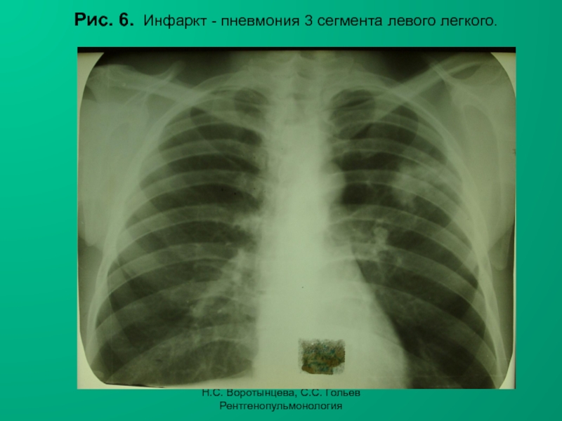 Н.С. Воротынцева, С.С. Гольев РентгенопульмонологияРис. 6. Инфаркт - пневмония 3 сегмента левого легкого.