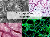troboz_embolia_staz.ppt