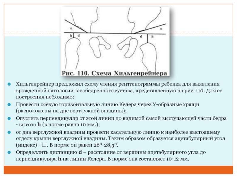 Схема врожденного вывиха бедра