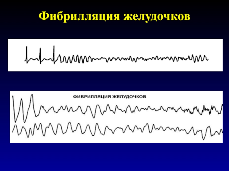 Фибрилляция желудочков фото