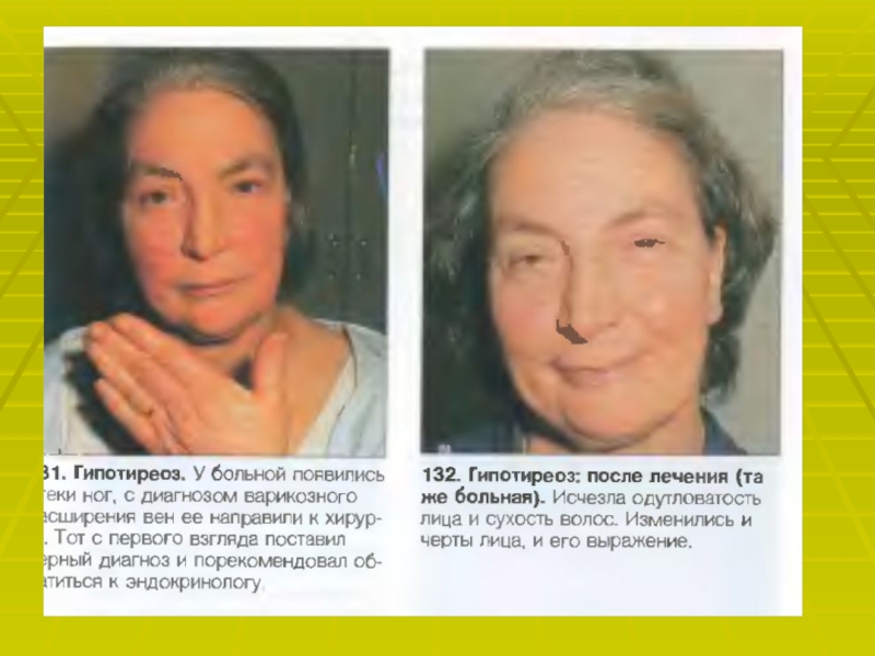 Гипотиреоз лечение у женщин после 50 лет. Признаки гипотиреоза у женщин. Тяжелая форма гипотиреоза.