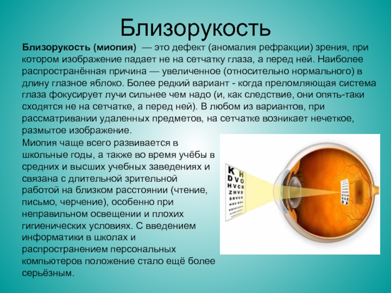 Миопия сетчатки. Миопия глазное дно дегенеративная. Миопия сетчатки глаза. Дегенеративная миопия сетчатка. Высокая миопия.