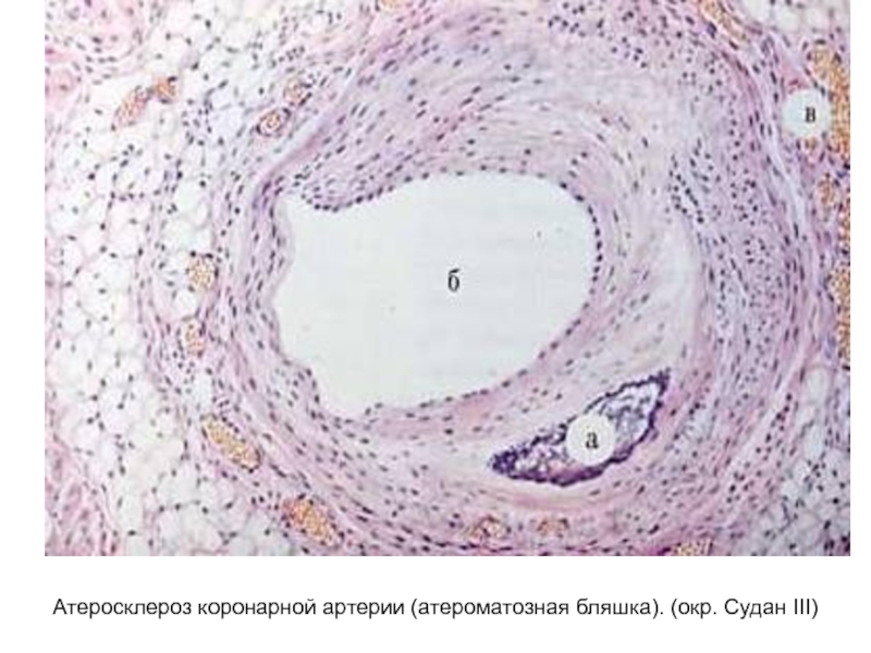 Атеросклероз коронарной артерии (атероматозная бляшка). (окр. Судан ІІІ)
