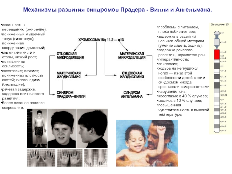 Синдром развития. Прадера Вилли характеристика кариотипа. Микроцитогенетические синдромы: Прадера - Вилли. Микроделеция хромосомы. Синдром Прадера-Вилли. Синдром Прадера Вилли Тип наследования.