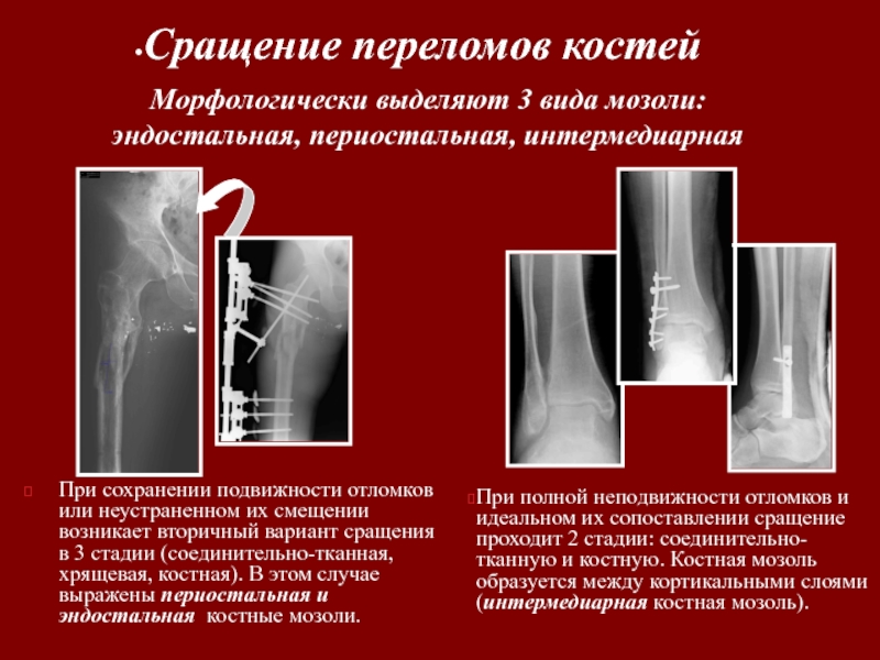 Эндостальная мозоль. Периостальная реакция кости. Линейная периостальная реакция. Периостальная реакция при переломе. Выраженная периостальная реакция.