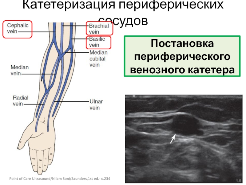 Вена расположена. Катетеризация периферической вены. Периферическая Вена катетеризация.