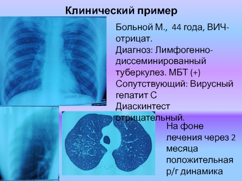 Туберкулез и гепатиты презентация