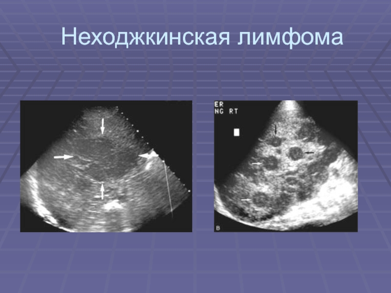 Неходжкинская лимфома презентация