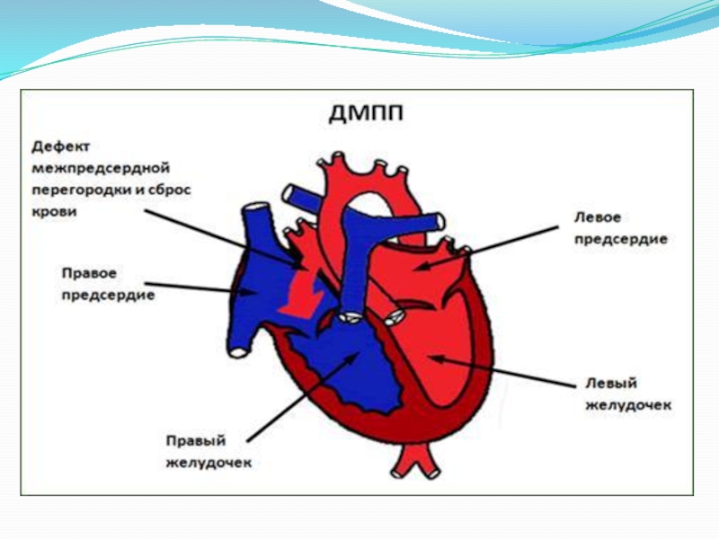 Дмпп аускультативная картина