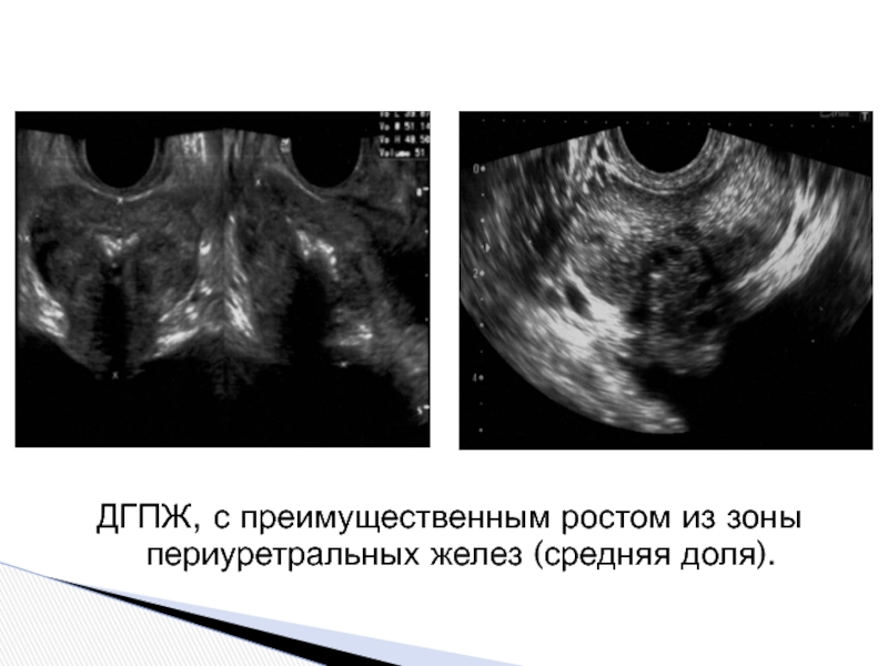 Гиперплазия предстательной железы 1. Аденома предстательной железы на УЗИ. Гиперплазия предстательной железы УЗИ. ДГПЖ на УЗИ предстательной железы.