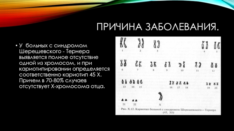 Синдром шерешевского тернера презентация неврология