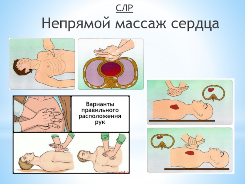 Презентация на тему непрямой массаж сердца