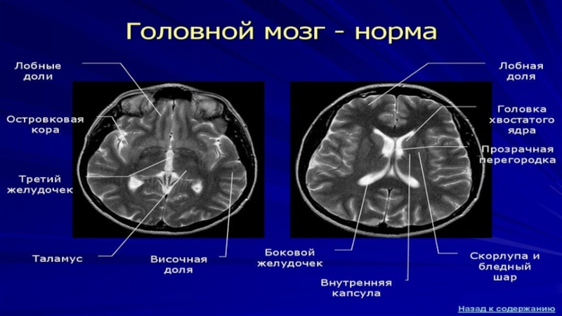 Диагноз головы. Киста прозрачной перегородки головного мозга кт. Прозрачная перегородка головного мозга кт. Полость прозрачной перегородки головного мозга. Агенезия прозрачной перегородки головного мозга на кт.