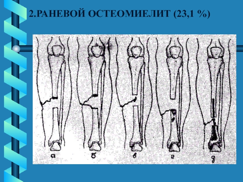 Огнестрельный остеомиелит. Огнестрельный остеомиелит рентген.