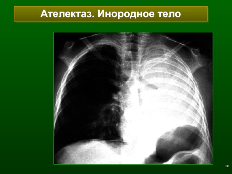 Ателектаз легкого. Компрессионный ателектаз рентген. Травматический ателектаз легкого. Хвост кометы ателектаз. Ателектаз легкого инородное тело.