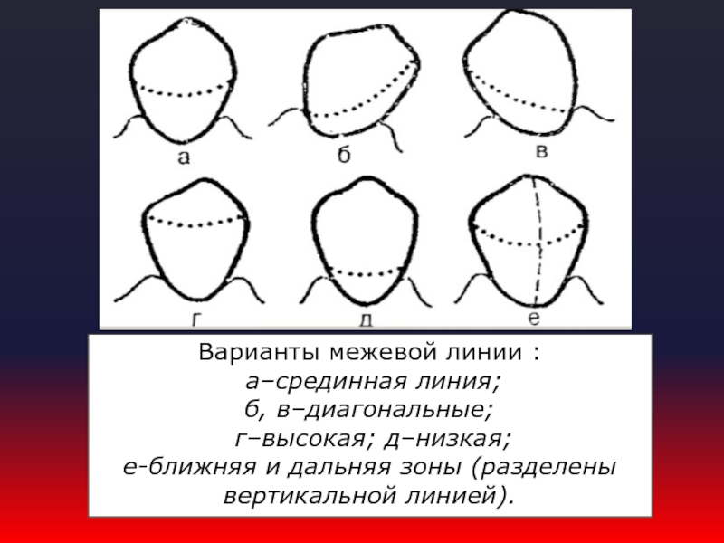 Кламмерная линия на нижней челюсти