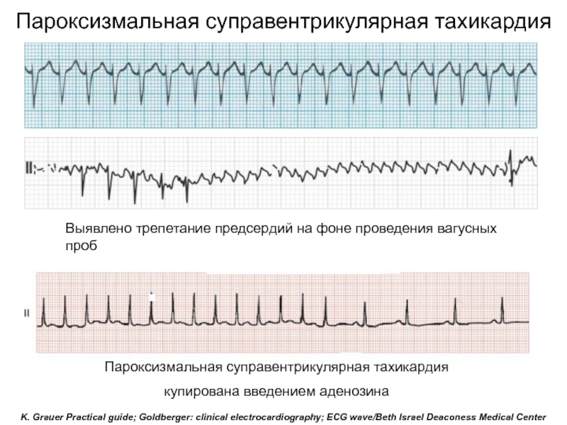 Экг картина при пароксизме суправентрикулярной тахикардии имеет вид