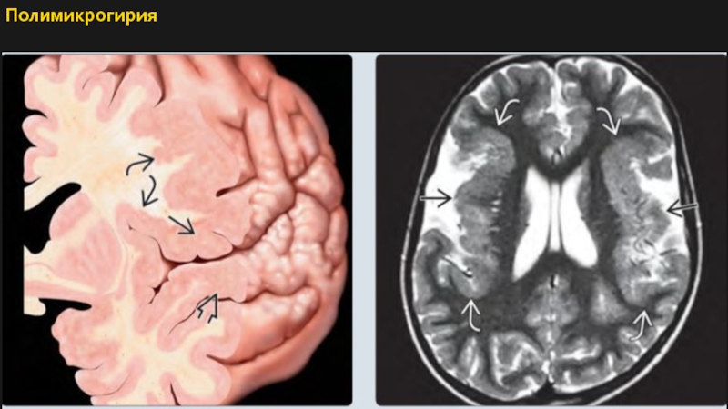 Пахигирия. Лиссэнцефалия-пахигирия. Микрогирия мрт. Полимикрогирия мрт. Порэнцефалическая киста на кт.