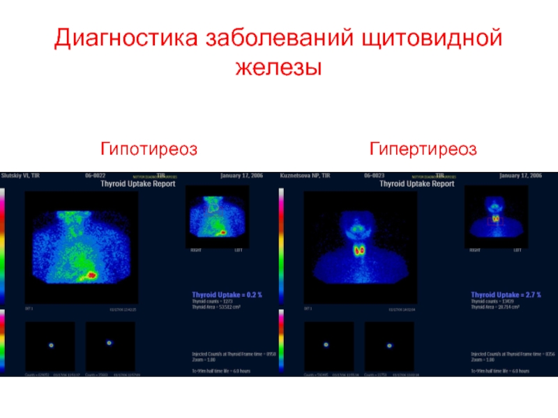 Сцинтиграфия щитовидной железы картинки