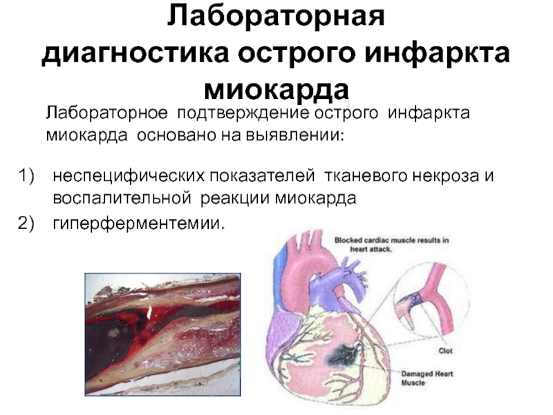 Изменения в миокарде что это значит