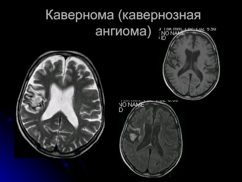 Ангиома правой лобной. Кавернома головного мозга кт. Кавернозная ангиома головного мозга. Кавернома на кт.