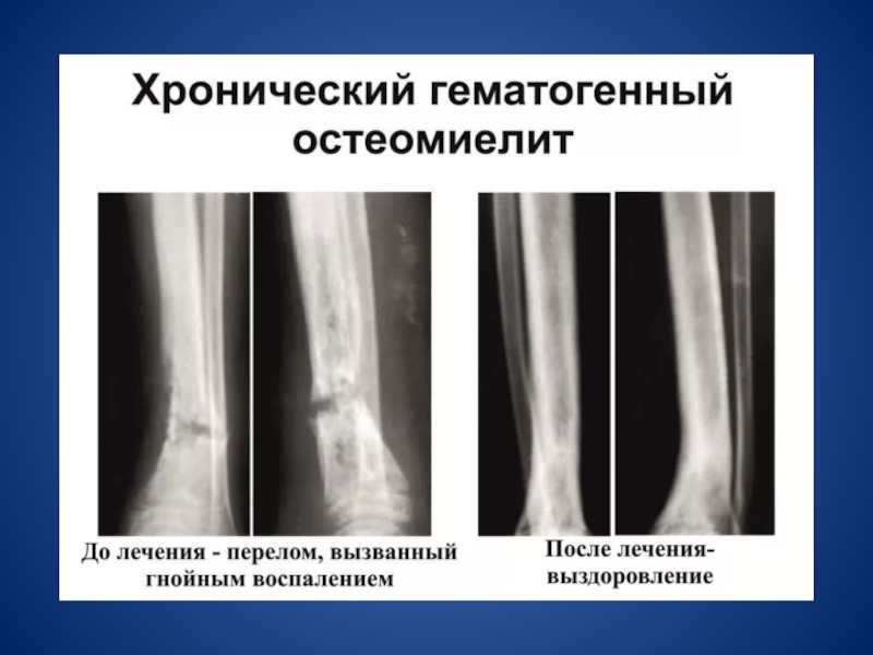 Острый остеомиелит клиническая картина