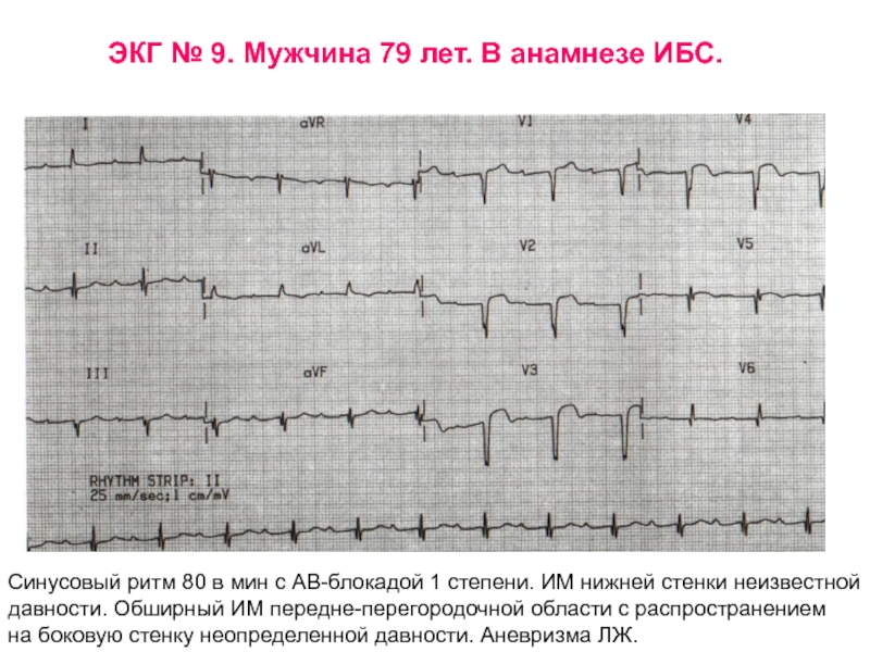 Синусовый ритм на экг. Синусовый ритм с атриовентрикулярной блокадой 1 степени. Синусовая тахикардия с АВ блокадой 1 степени. Признаки АВ блокады 1 степени на ЭКГ. Синусовый ритм 80.