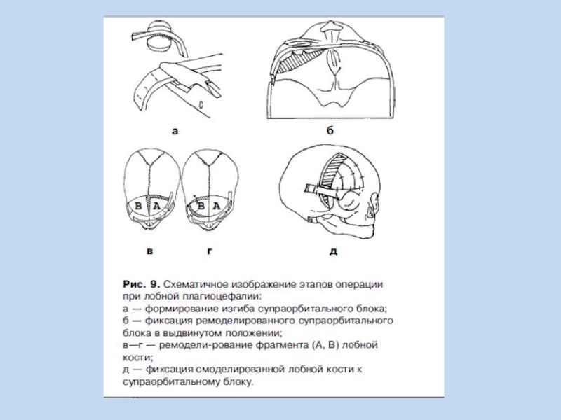 Фиксация изображения. Супраорбитальный доступ. Латеральный супраорбитальный доступ. Выпиливание супраорбитального блока.