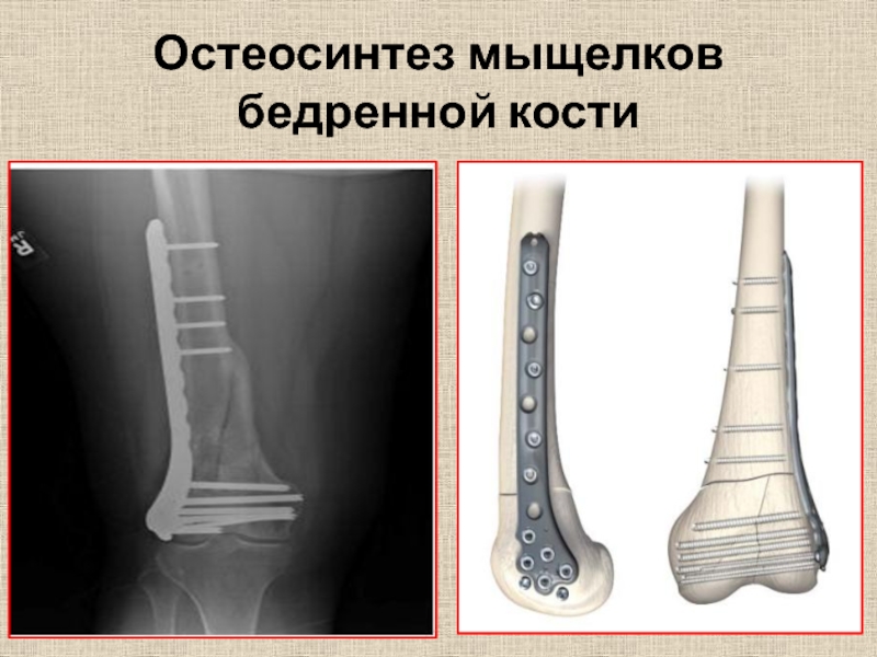 Остеосинтез мыщелка. Перелом мыщелка бедренной кости. ИМПЛАСТ остеосинтеза бедренной кости. Перелом мыщелка большеберцовой кости остеосинтез рентген.