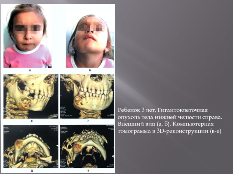 Ребенок 3 лет. Гигантоклеточная опухоль тела нижней челюсти справа. Внешний вид (а, б). Компьютерная томограмма в 3D-реконструкции
