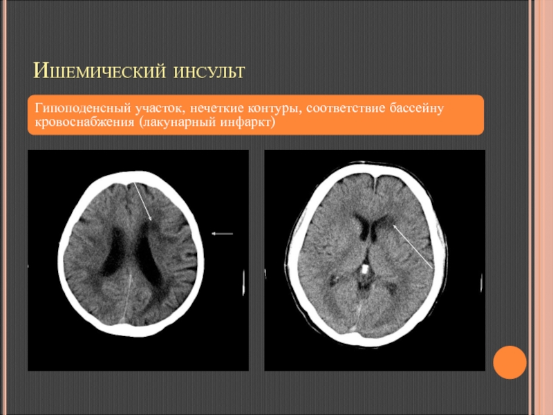 Ишемический инсульт карта