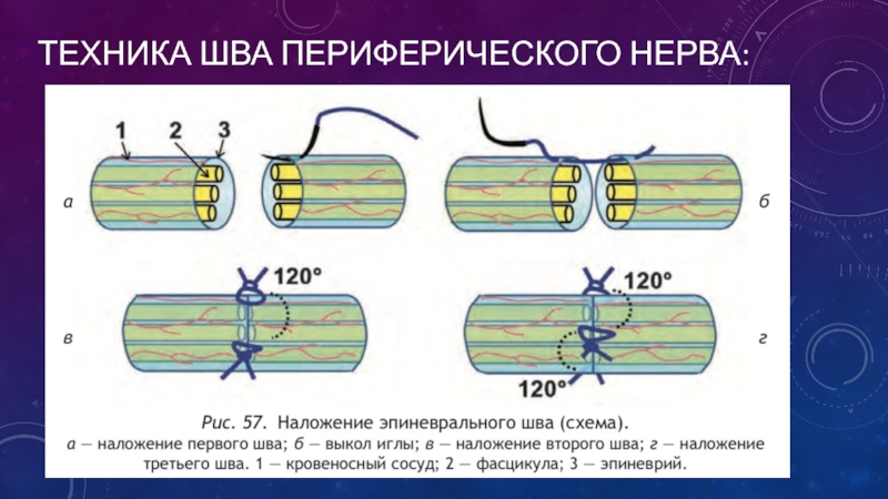 Шов нерва презентация